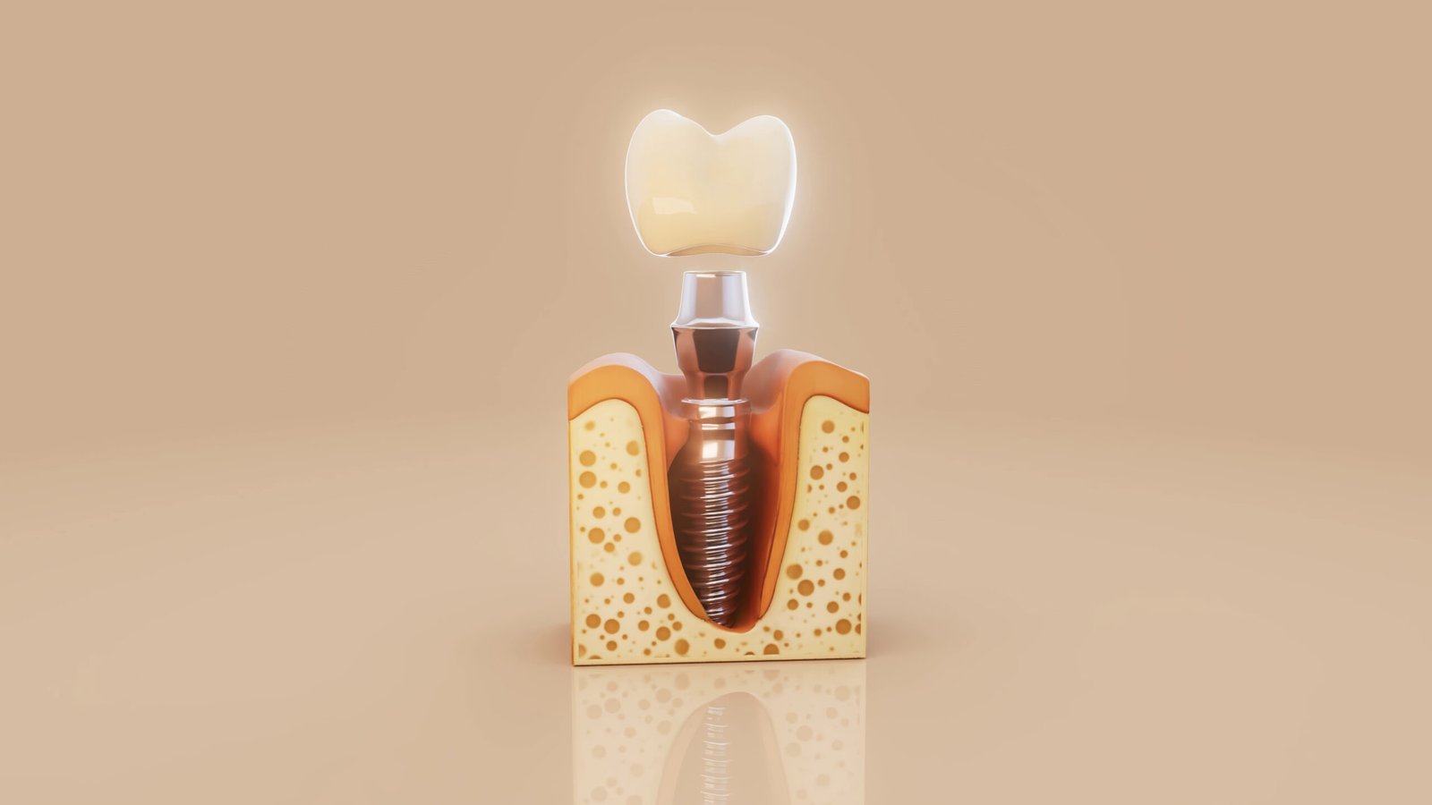 implant dentaire prix maroc - racine artificielle en titane dans l'os de la mâchoire