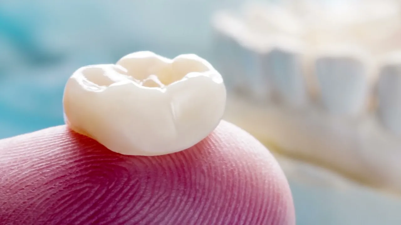 couronne dentaire - dentiste posant une prothèse esthétique