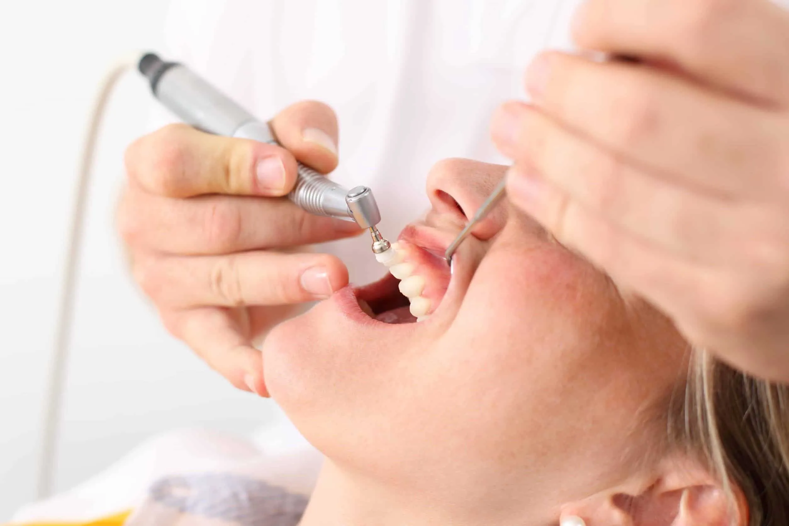 détartrage prix maroc - nettoyage professionnel chez le dentiste